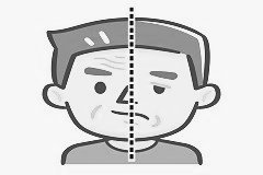 schemenhafte Zeichnung einer Facialisparese